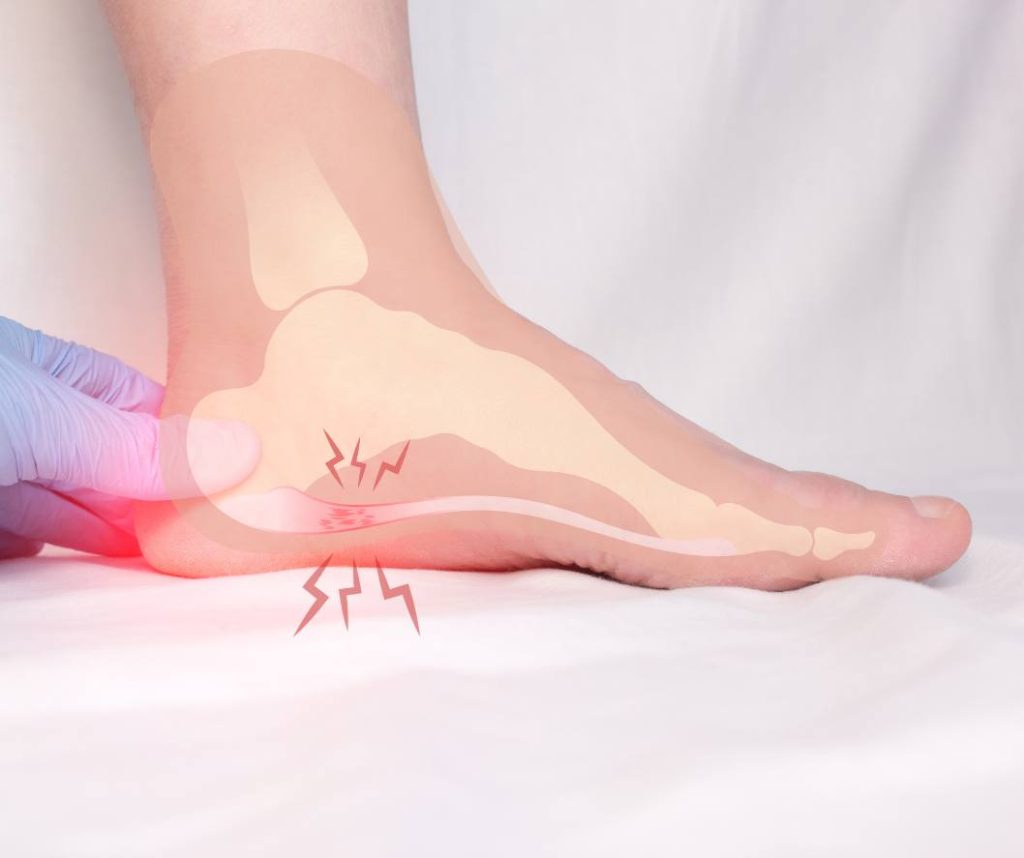An illustration of plantar fasciitis showing an affected plantar fascia conneting the toe and heel bone.