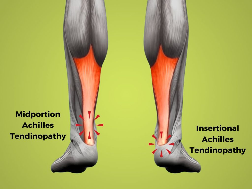 An illustration of the achilles tendon and the locaiton of pain in midportion vs. insertional tendinopathy