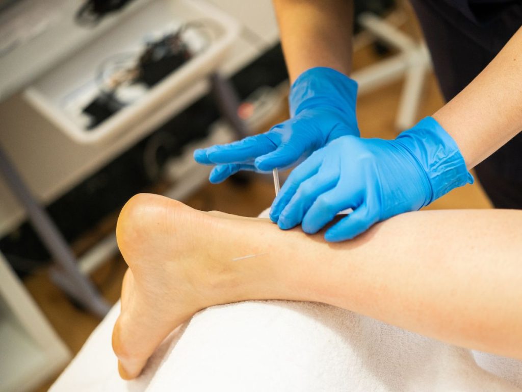 Dry Needling - Achilles Tendinopathy