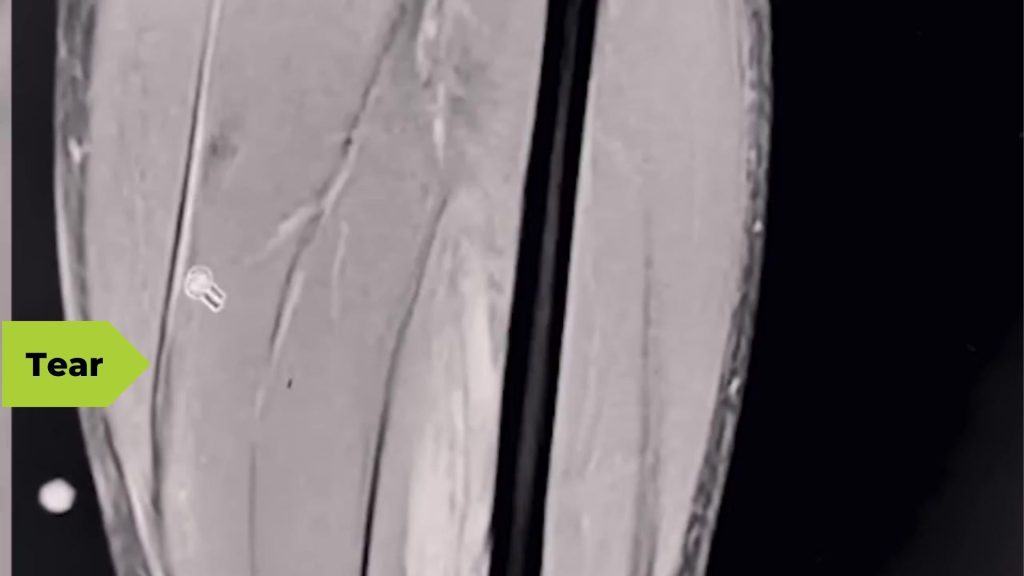 Although Lucy Charles-Barclay's calf tear was aggravated during her run in Kona 2023, it did not hugely impact her running form